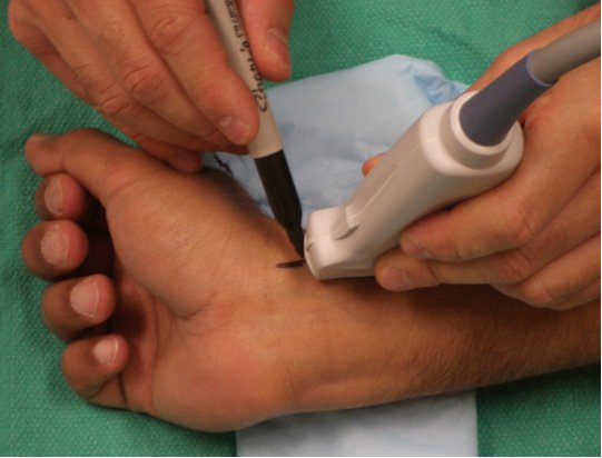 Indirect technique for radial artery catheterization.