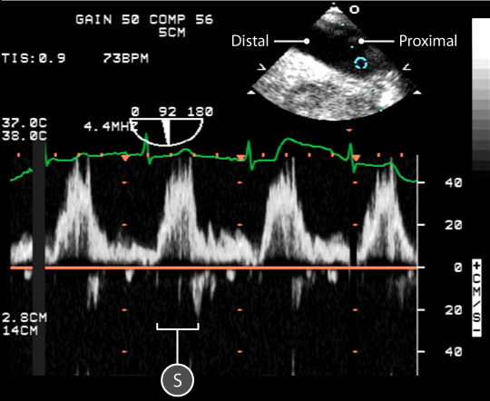 pulse wave spectral doppler of descending aorta